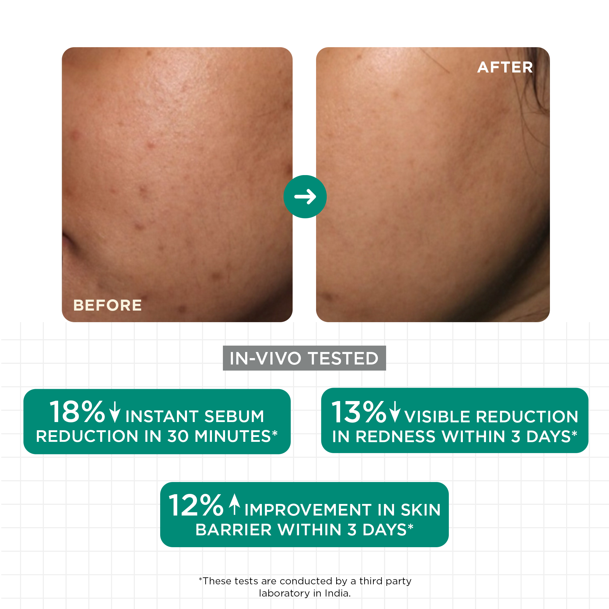 Acne & Oil Control Serum